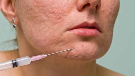 How to Treat Pitted Acne Scars?