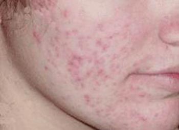 What are the treatments of Acne pitted scars